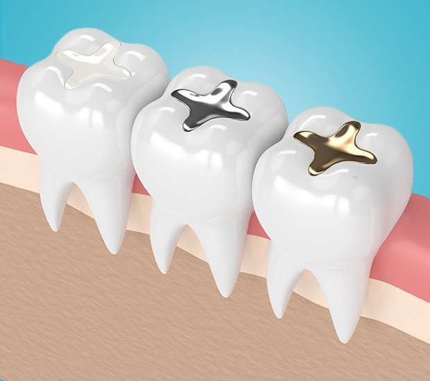 Paris Composite Fillings
