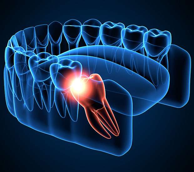 Paris Wisdom Teeth Extraction